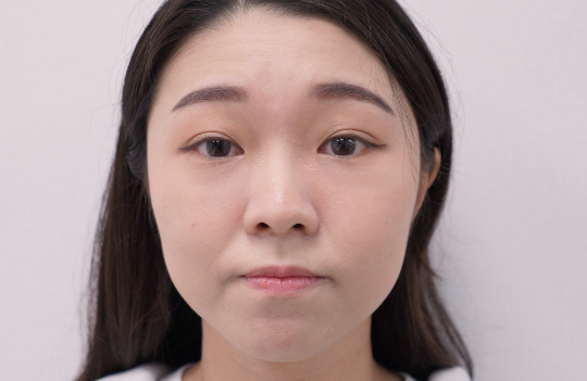 隱痕眼袋手術After